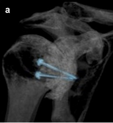 Posterior Bone Block CT